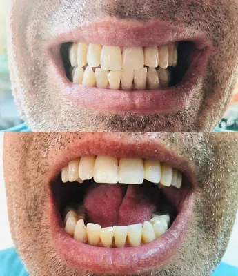 Мои зубы выпали на следующий день после имплантации. Но Bookimed помог все  исправить“: история пациента об имплантации зубов