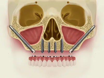 Имплантация верхних передних зубов – цена в Москве | Стоматология Максима  Шубных