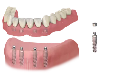 Раздел протезирование зубов