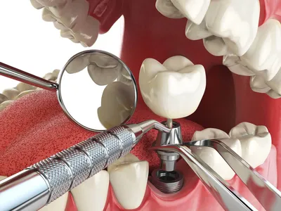 Чем опасна имплантация зубов