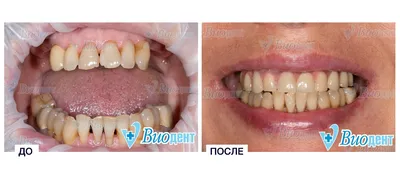 Фото зубов до и после посещения стоматологии. Имплантация зубов.