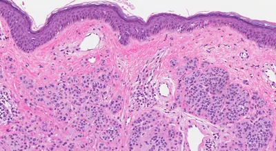 Дермальный невус | MyPathologyReport.ca