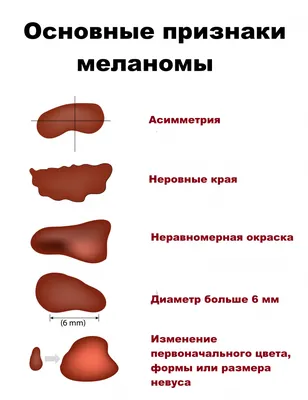 Изменение родинки - причины появления, при каких заболеваниях возникает,  диагностика и способы лечения