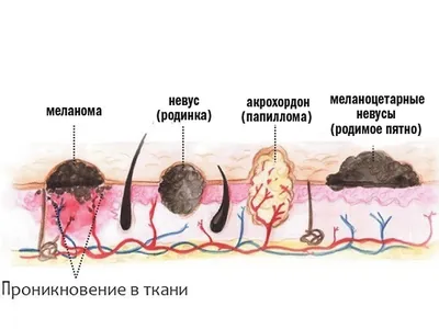 FAQ: Правда ли, что, если повредить родинку, можно умереть?