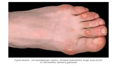 Какие бывают шишки на пальцах ног