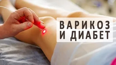 Лечение варикоза ног при сахарном диабете - «Институт Вен» лечение варикоза  в Киеве и Харькове
