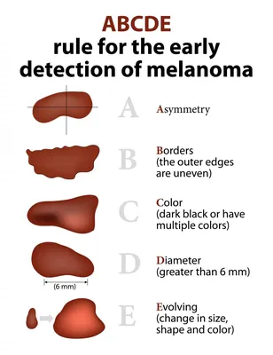 Меланома кожи - симптомы, фото, признаки, лечение, прогноз выживаемости
