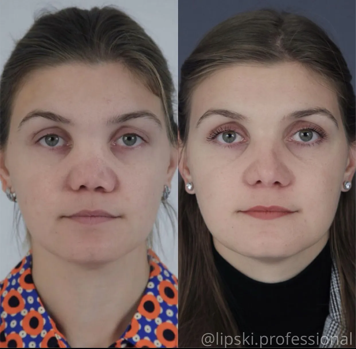 Ринопластика курносого носа до и после фото
