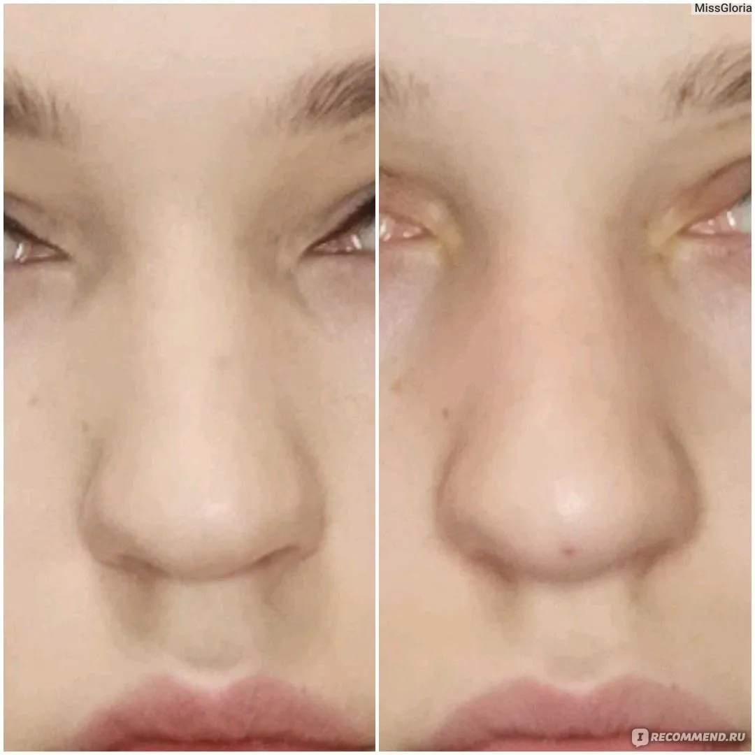 Гиалурон в нос фото до и после