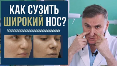 КАК СУЗИТЬ ШИРОКИЙ НОС: 💉УКОЛЫ ИЛИ ОПЕРАЦИЯ? - YouTube