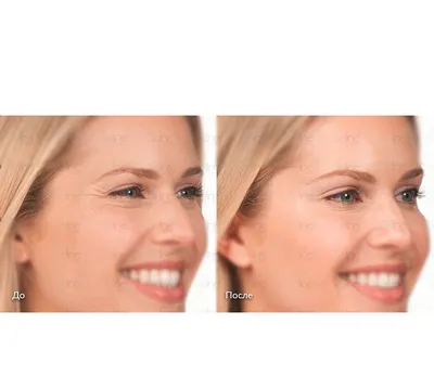 Фото до и после - Инъекционная косметология - клиника Seline