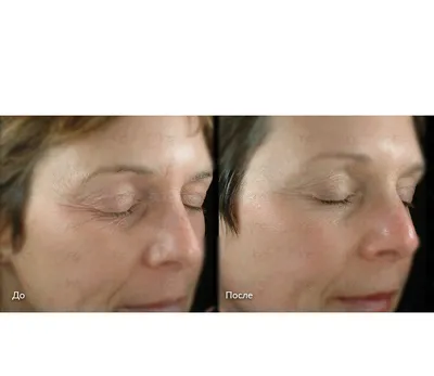 Фото до и после - Инъекционная косметология - клиника Seline