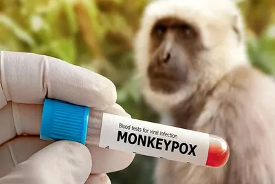 В США начали набор пациентов с оспой обезьян для участия в исследовании  препарата TPOXX | Новости | GxP News