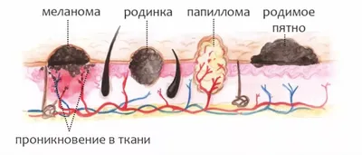 Рак кожи: симптомы, фото, диагностика и лечение