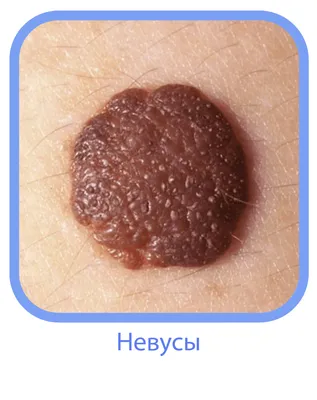 Как выглядит рак кожи и как распознать меланому или базалиому, фото  злокачественных новообразований на коже - 2 августа 2022 - chita.ru