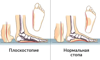 ПЛОСКОСТОПИЕ И ДЕТСКАЯ ОРТОПЕДИЧЕСКАЯ ОБУВЬ