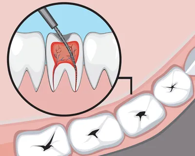 ᐈ Воспаление зубного нерва: Cимптомы, осложнения и лечение