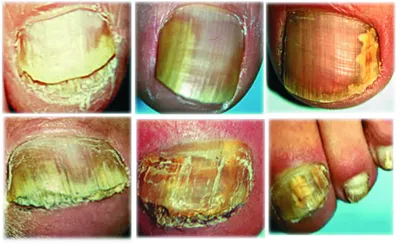 Онихомикоз фотографии