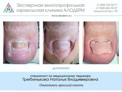 Лечение онихомикоза лазером в Москве | Клиника АЛОДЕРМ , Москва