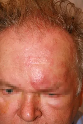 Опоясывающий лишай на лице: фото, симптомы и лечение. Откуда опоясывающий  лишай на лице