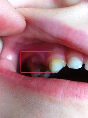 Гноится десна после удаления зуба — 4 причины, 5 симптомов и лечение |