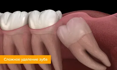 Отек после удаления зуба: сколько держится и что делать, если припухлость  не проходит?