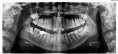 Удаление зубов - «Моя история удаления ретинированных зубов мудрости +  много фото. Какие осложнения меня коснулись? » | отзывы