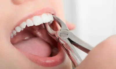 Удаление зуба в Киеве ᐉ Стоматологическая клиника Dental Art