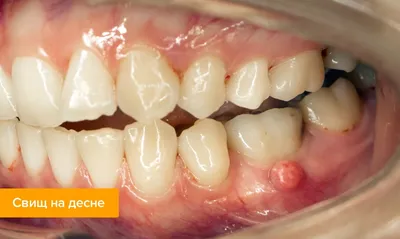 ᐈ Синяк после обезболивания зуба: причины появления, чем опасен, как лечить