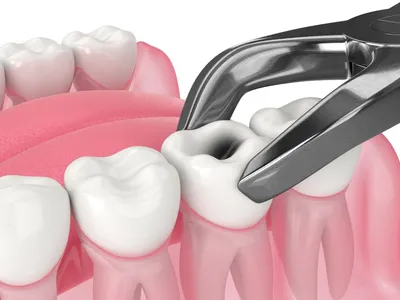 Удаление зуба – как вести себя после процедуры? - Periodent