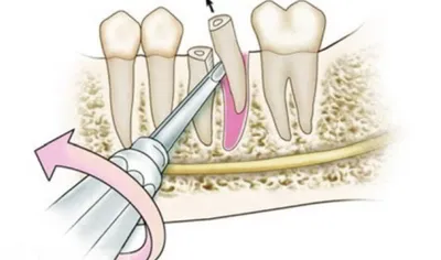 Удаление корня зуба - показания, подготовка к операции, инструменты, этапы  удаления, осложнения