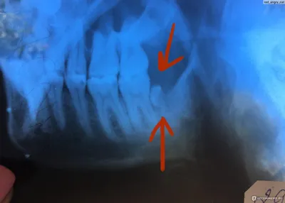 Удаление зубов - «Моя история удаления ретинированных зубов мудрости +  много фото. Какие осложнения меня коснулись? » | отзывы
