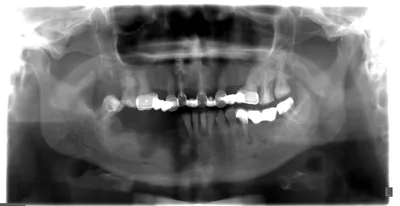 Остеомиелит нижней челюсти | Портал радиологов