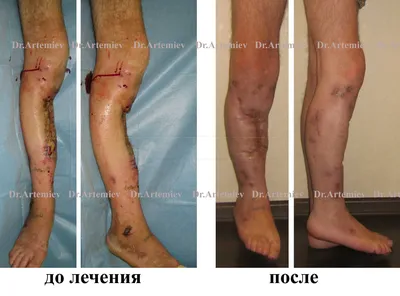 Лечение остеомиелита клиника в Москве