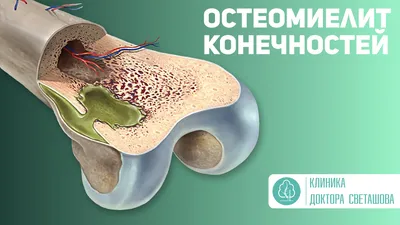 Клиника доктора Светашова - Лечение остеомиелита конечностей