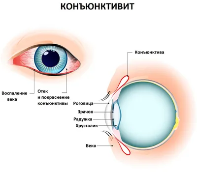 Отек Квинке у детей и взрослых - как снять аллергический отек