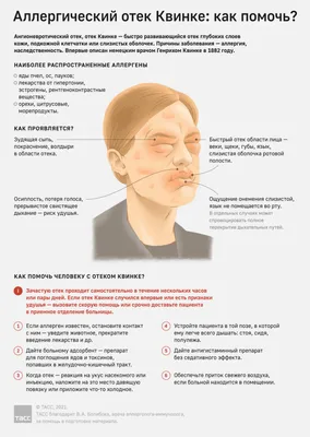Что делать при аллергическом отеке Квинке - Инфографика ТАСС