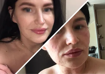 Будто кипяток под кожей»: жительница Новосибирска получила отёк Квинке  после процедуры у косметолога на дому - sib.fm
