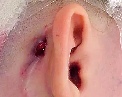 Лечение грибка в ушах (отомикоз) у детей и взрослых