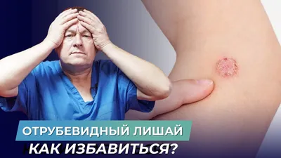 Как вылечить отрубевидный лишай? - YouTube