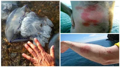 Курорт на Азовском море атаковали медузы: у отдыхающих ожоги. Фото и видео  | Новости | OBOZ.UA