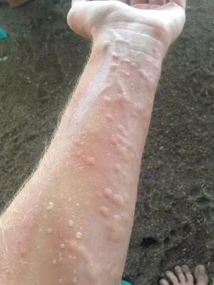 В БСМП Челнов мужчине после ожога медузы пересадили кожу на руке