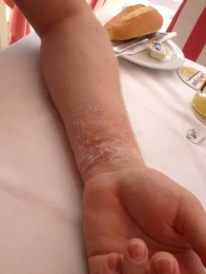 В БСМП Челнов мужчине после ожога медузы пересадили кожу на руке