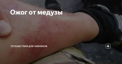 Ольга Суханова on X: \"Ожог от медузы. Рука не моя. http://t.co/UZbJWzBE\" / X