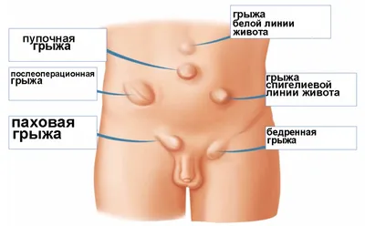 Тендинопатия приводящих мышц бедра - KinesioPro