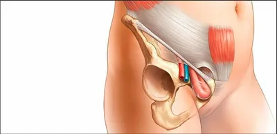 Тендинопатия подвздошно-поясничной мышцы - KinesioPro
