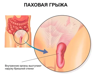 Медичний центр \"Еввіва\" - Паховая грыжа - это выпячивание части кишечника  или иной ткани брюшной полости через просвет между мышцами нижней части  живота (паховый канал). Если наблюдаете выпуклость с одной из сторон