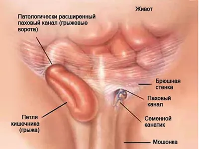 Паховая грыжа выход кишечника через стену полости брюшка Иллюстрация  вектора - иллюстрации насчитывающей подбрюшные, ацетона: 146843323