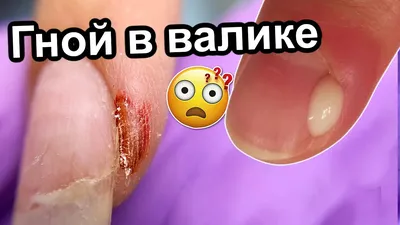 Воспаление После Маникюра 😱 Панариций | Причины и Лечение | Обработка  Пораженного Ногтя - YouTube