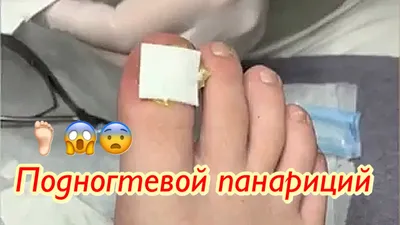 Подногтевой панариций🦶🏻😱😨 - YouTube